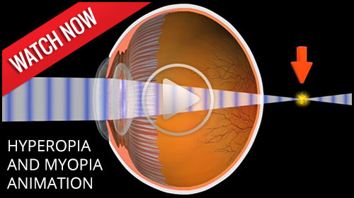 hyperopia and myopia