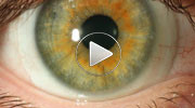 Insertion and removal of scleral contact lenses