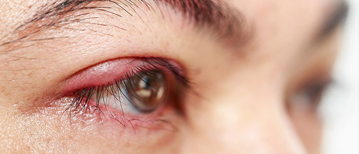 Skulle skam Kakadu What can I do for my red and itchy eyelids? - Eye Doctor | Adult & Child Eye  Care | Spokane | Spokane Valley