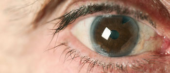 Do I really need cataract surgery?