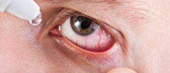 Is it safe to use redness relief eye drops