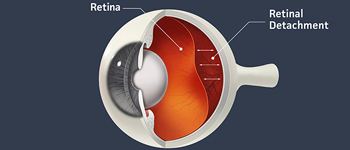 Retinal Detachment - Symptoms, Signs and Treatment