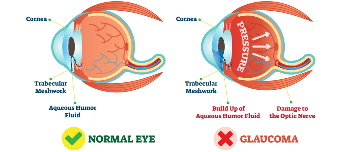 Newly Diagnosed with Glaucoma? Here are some treatment options.