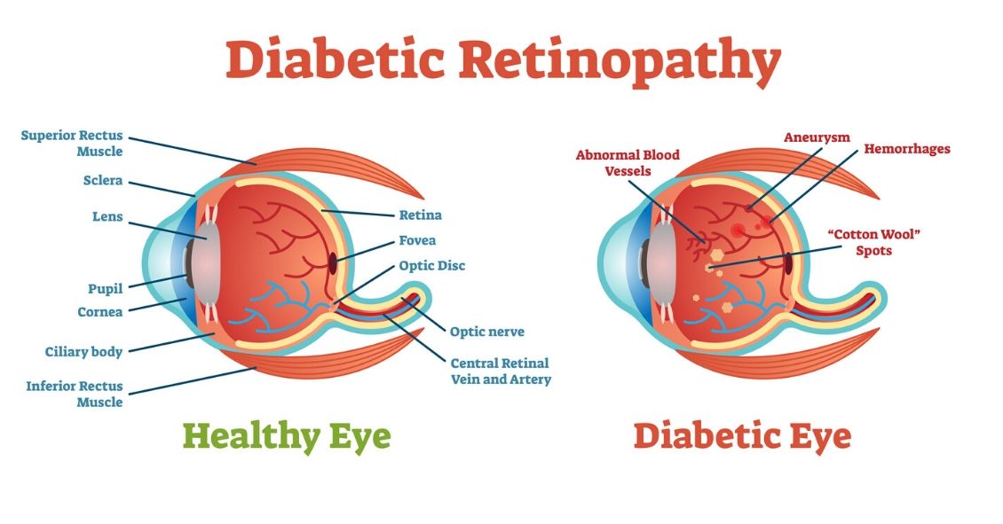 Diabéteszes retinopátia tünetei és kezelése - HáziPatika