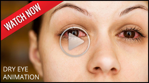 dry eye syndrome