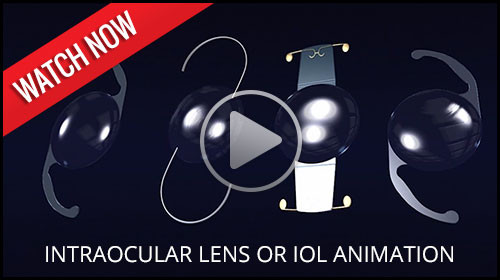 Intraocular lens or IOL