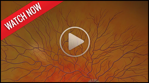 Diabetic Retinopathy