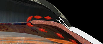 Glaucoma - Narrow and Closed Angle