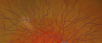 Diabetic Retinopathy