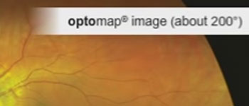 Optomap Comparison view of retinal exam