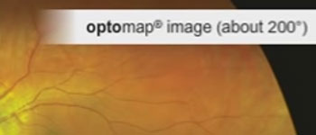 Optomap Comparison view of retinal exam