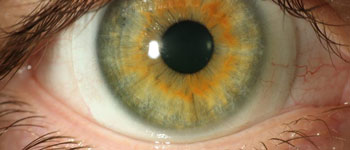 Scleral Lens Society Insertion, Removal, Troubleshooting and Lens Care Video