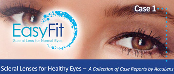 Scleral Lenses for Healthy Eyes #1