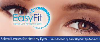 Scleral Lenses for Healthy Eyes Case #2