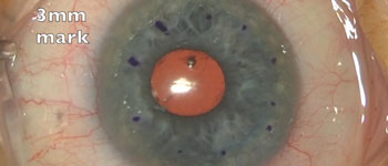DMEK with TBI tissue explained