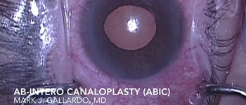ABiC According to the Expert - Mark J. Gallardo, MD (El Paso Eye Surgeons, Texas)