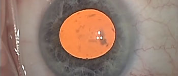 Ab-Interno Canaloplasty: A Comprehensive Approach to MIGS