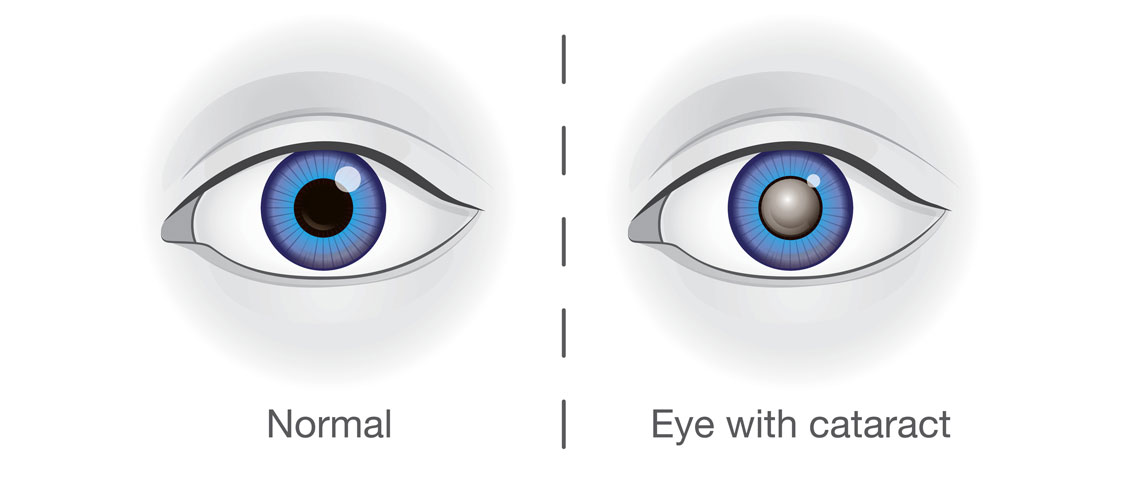 Why Do I have to Pay Out of Pocket for Cataract Surgery?