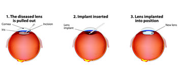 Should I Pay out of Pocket for Cataract Surgery?