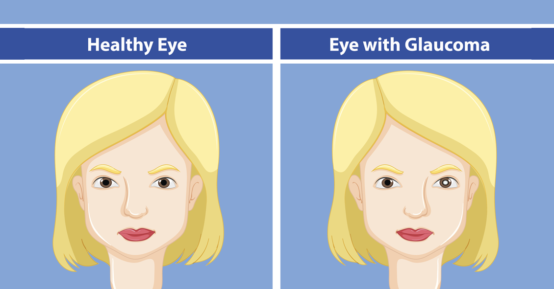 Newly Diagnosed with Glaucoma? What Now?