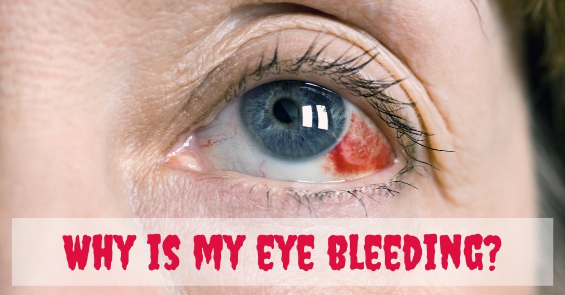 Is My Eye Bleeding?