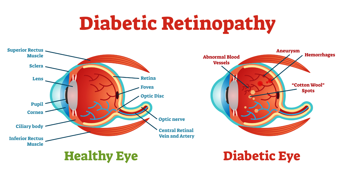 Diabetic Retinopathy Basics