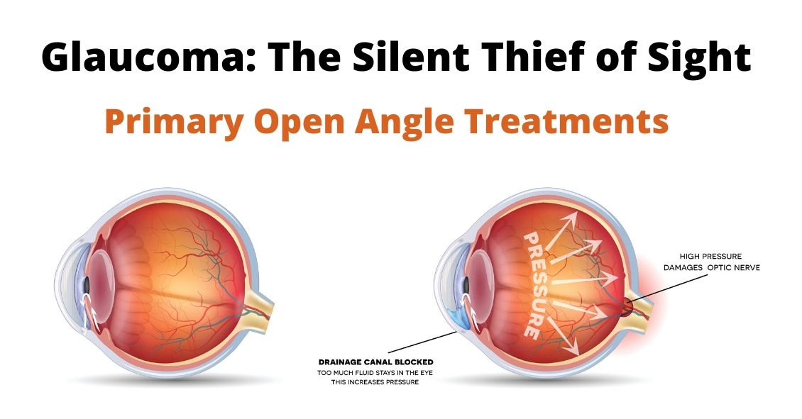 Primary Open Angle Glaucoma