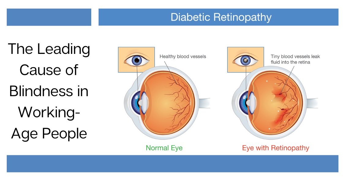 The Leading Cause of Blindness in Working-Age Adults