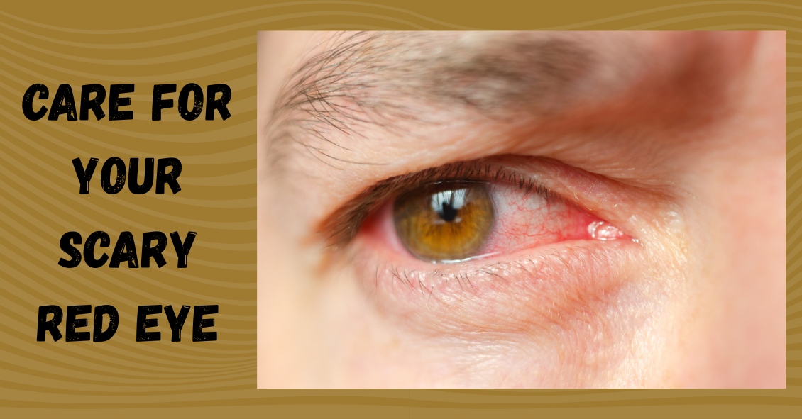 Care for Your Scary Red Eye