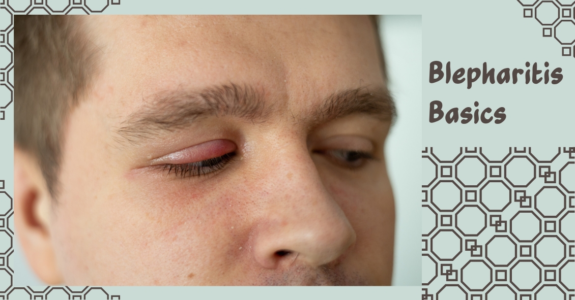 Blepharitis Basics