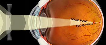 Refractive Error